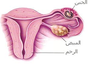 الحمل خارج الرحم،اسباب الحمل خارج الرحم